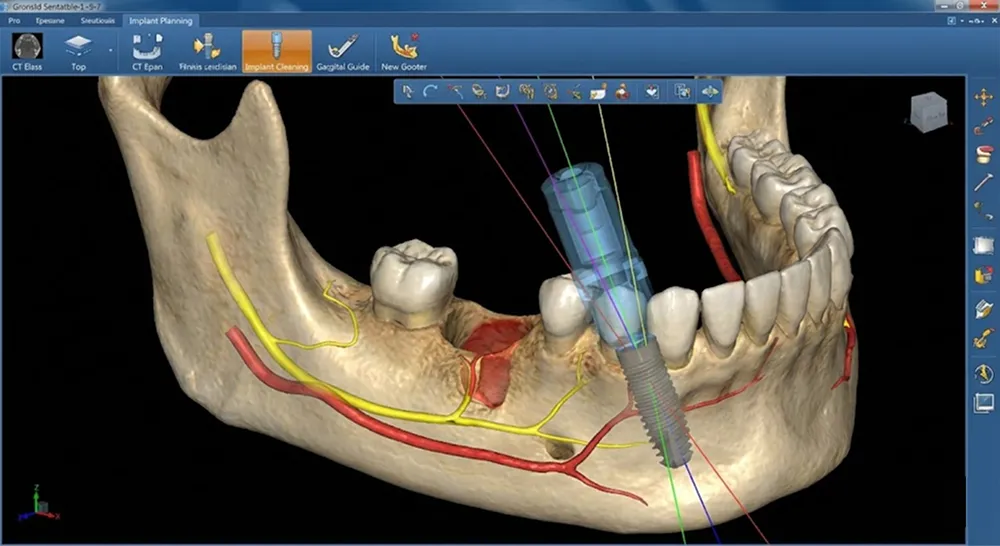 3Dコンピューターインプラント