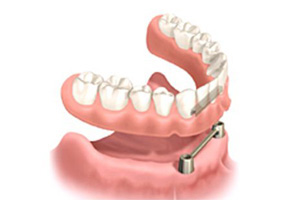 インプラントオーバーデンチャー
