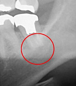 デンタルレントゲン