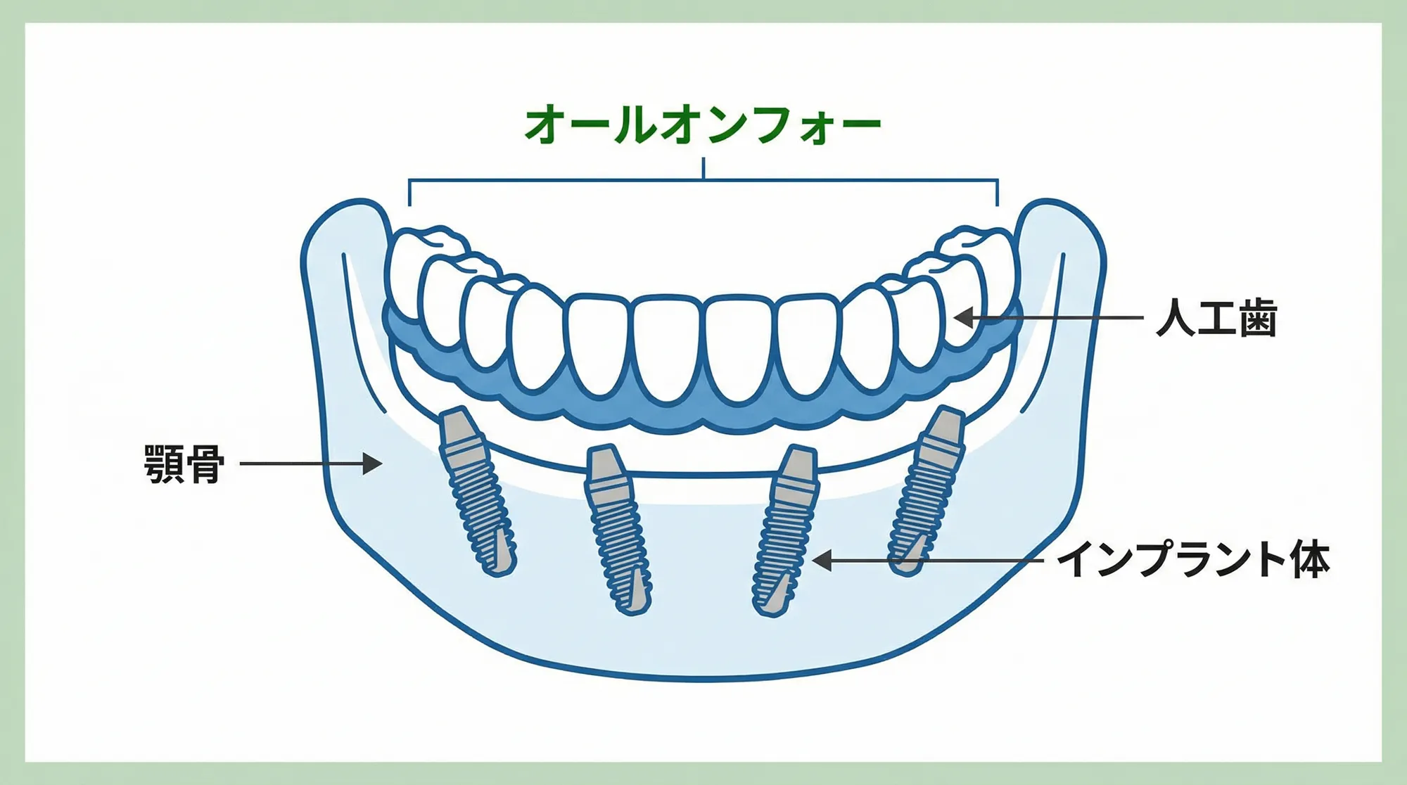オールオン4とは