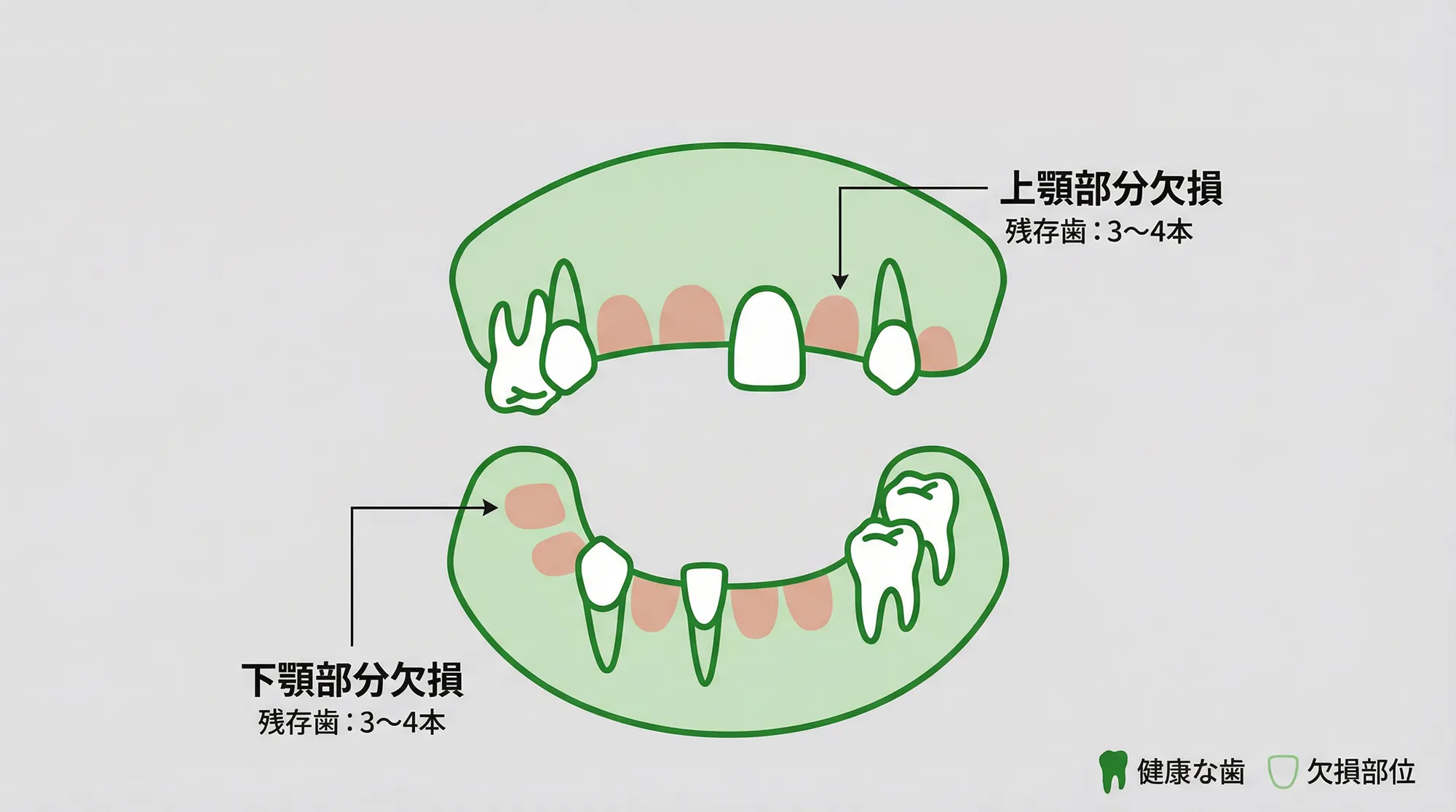 残っている歯が少ない方